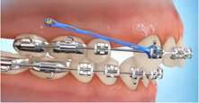 Ortodontinis mini implantas